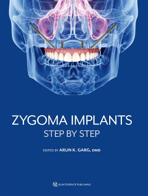Zygoma Implants - Arun K. Garg