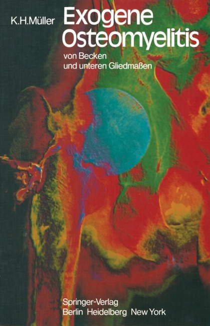 Exogene Osteomyelitis von Becken und unteren Gliedmaßen - K. H. Müller