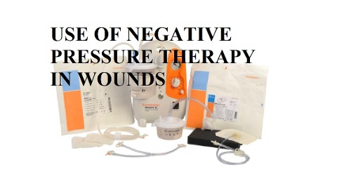 USE OF NEGATIVE PRESSURE THERAPY IN WOUNDS - Pilar Calvo Mur, Raquel Sesma Sobejano, Maria Teresa de León Cano, Patricia Jiménez Azparren, Isabel Ardaiz Martin