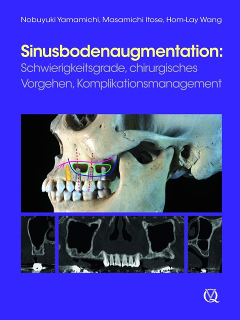 Sinusbodenaugmentation - Nobuyuki Yamamichi, Masamichi Itose, Hom-Lay Wang