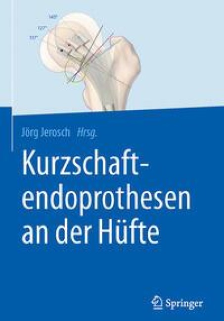 Kurzschaftendoprothesen an der Hüfte - 