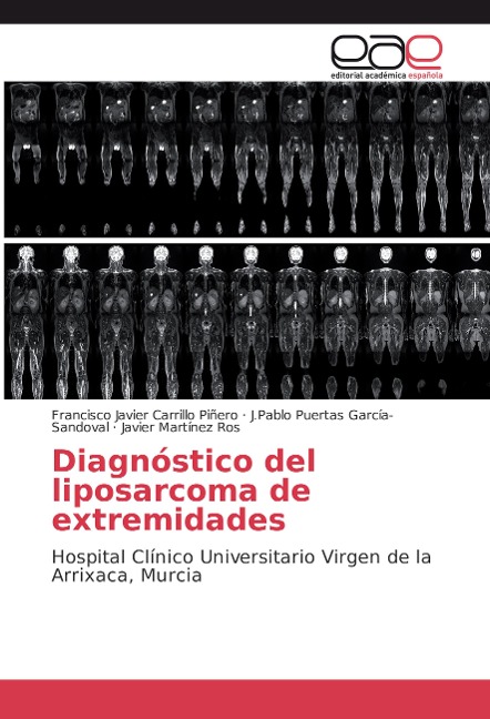 Diagnóstico del liposarcoma de extremidades - Francisco Javier Carrillo Piñero, J. Pablo Puertas García-Sandoval, Javier Martínez Ros
