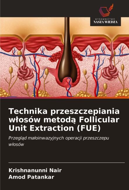 Technika przeszczepiania w¿osów metod¿ Follicular Unit Extraction (FUE) - Krishnanunni Nair, Amod Patankar