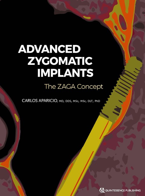 Zygomatic Implants - Carlos Aparicio
