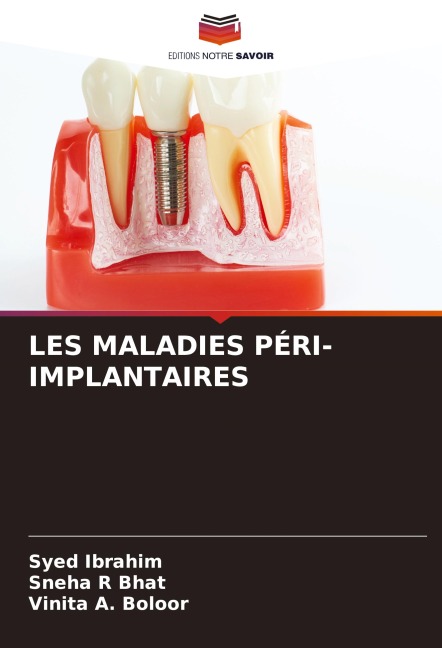 LES MALADIES PÉRI-IMPLANTAIRES - Syed Ibrahim, Sneha R Bhat, Vinita A. Boloor