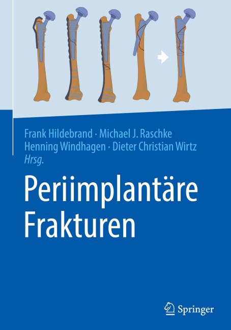 Periimplantäre Frakturen - 