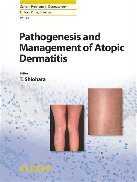Pathogenesis and Management of Atopic Dermatitis - 