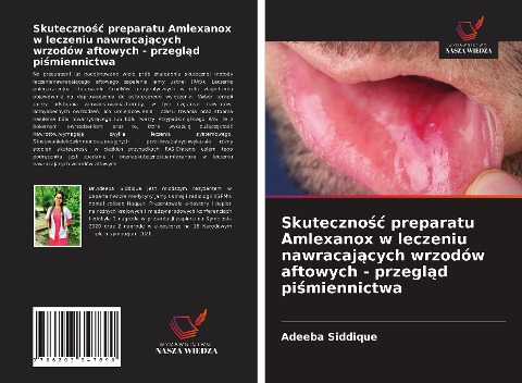 Skuteczno¿¿ preparatu Amlexanox w leczeniu nawracaj¿cych wrzodów aftowych - przegl¿d pi¿miennictwa - Adeeba Siddique
