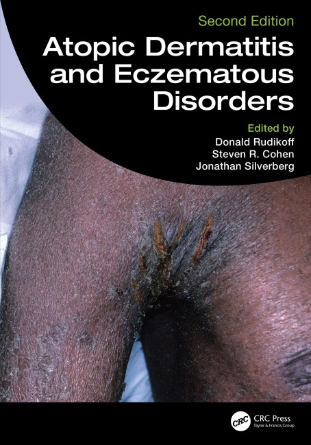 Atopic Dermatitis and Eczematous Disorders - 