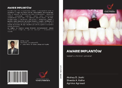AWARIE IMPLANTÓW - Akshay D. Joshi, Shweta A. Kolhe, Agrima Agrawal