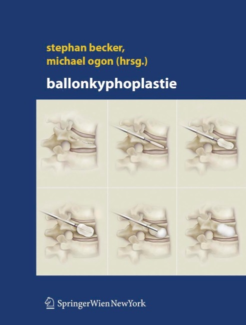 Ballonkyphoplastie - 
