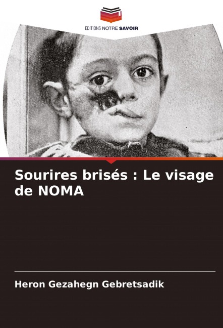Sourires brisés : Le visage de NOMA - Heron Gezahegn Gebretsadik