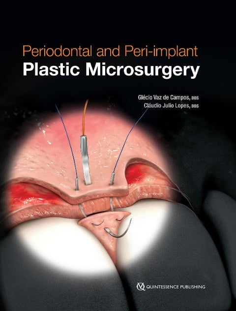 Periodontal and Peri-implant Plastic Microsurgery - Glécio Vaz de Campos, Cláudio Julio Lopes