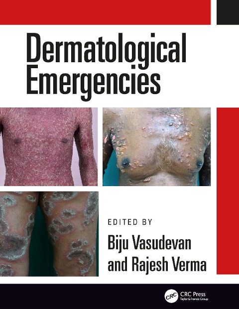 Dermatological Emergencies - 