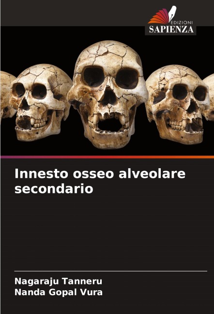 Innesto osseo alveolare secondario - Nagaraju Tanneru, Nanda Gopal Vura