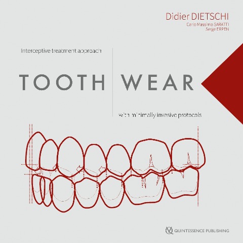 Tooth Wear - Didier Dietschi, Carlo Massimo Saratti, Serge Erpen