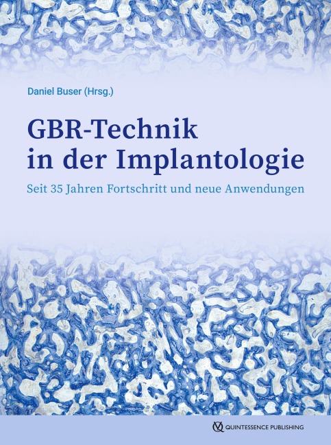 GBR-Technik in der Implantologie - 