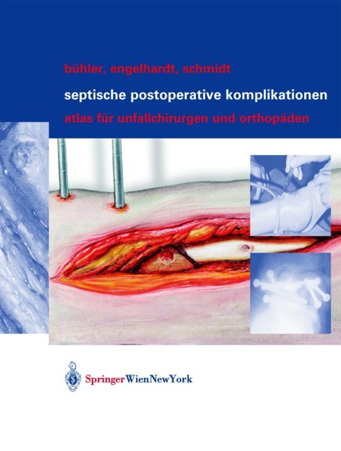 Septische postoperative Komplikationen - Matthias Bühler, Hergo G. K. Schmidt, Martin Engelhardt