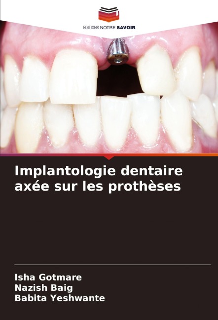 Implantologie dentaire axée sur les prothèses - Isha Gotmare, Nazish Baig, Babita Yeshwante