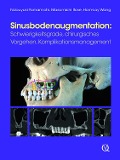 Sinusbodenaugmentation - Nobuyuki Yamamichi, Masamichi Itose, Hom-Lay Wang